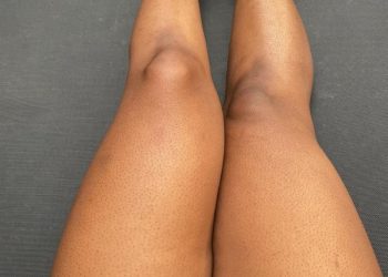 Strawberry Skin, What Are They and How To Get Rid Of Them