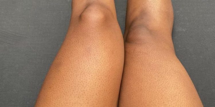 Strawberry Skin, What Are They and How To Get Rid Of Them